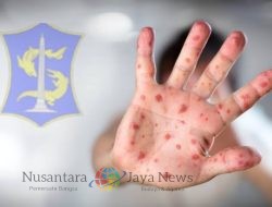 KENALI GEJALA TERTULAR FLU SINGAPURA, DINKES SURABAYA IMBAU MASYARAKAT TERAPKAN POLA HIDUP BERSIH DAN SEHAT