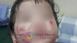 Kasus Kelalaian Daycare di Surabaya, Bayi Alami Luka Serius Diduga Digigit Teman: Polda Jatim Lakukan Penyelidikan