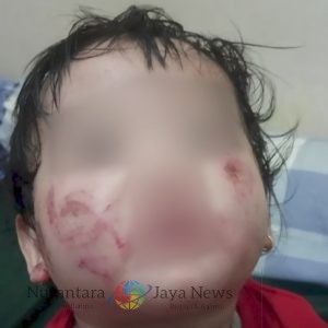 Kasus Kelalaian Daycare di Surabaya, Bayi Alami Luka Serius Diduga Digigit Teman: Polda Jatim Lakukan Penyelidikan